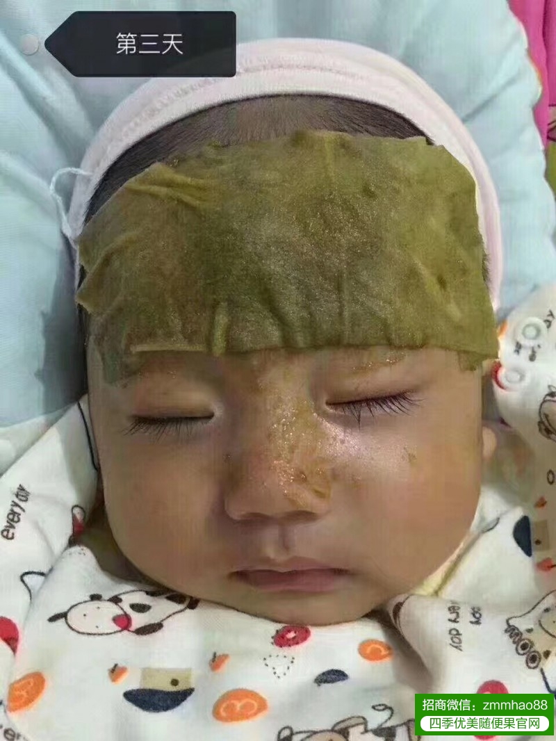 夏天湿热重，随便果水如何改善小孩湿疹？