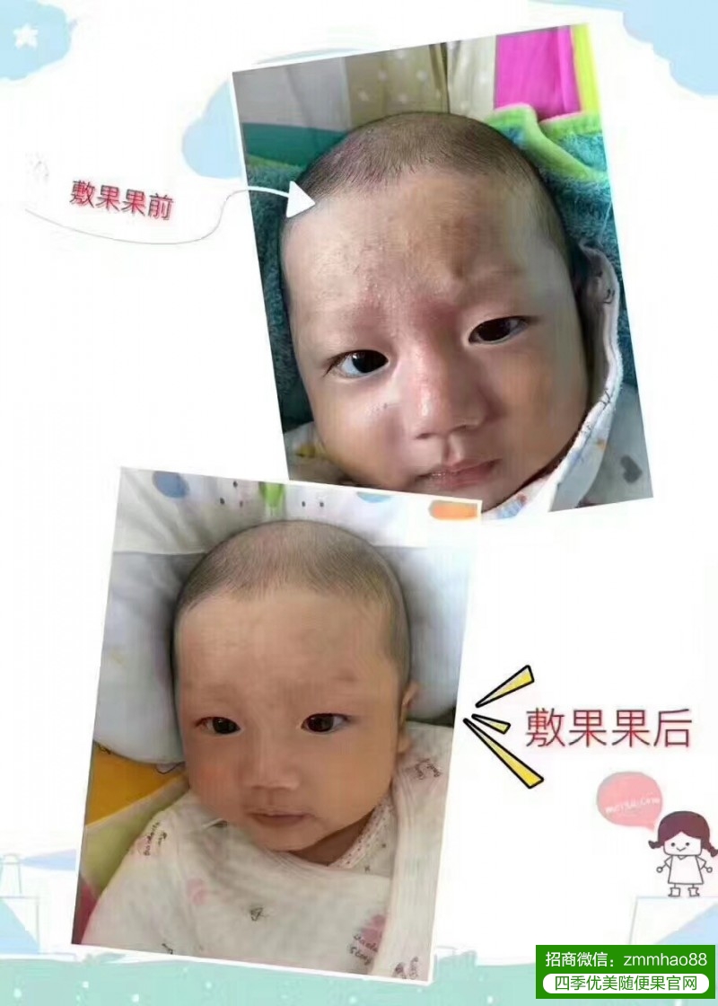 夏天湿热重，随便果水如何改善小孩湿疹？