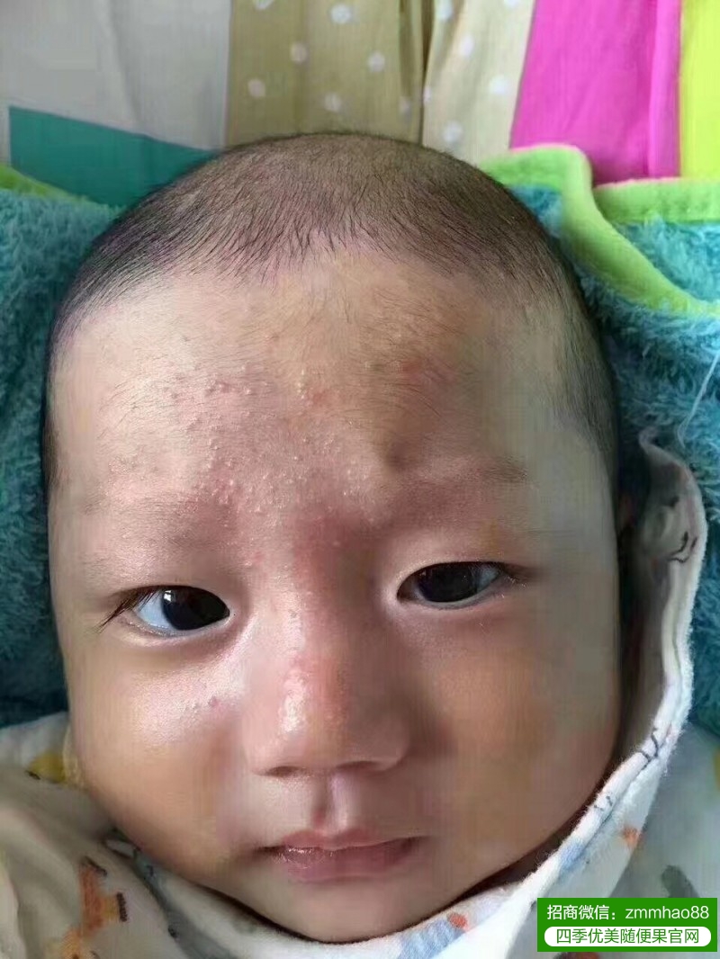 夏天湿热重，随便果水如何改善小孩湿疹？