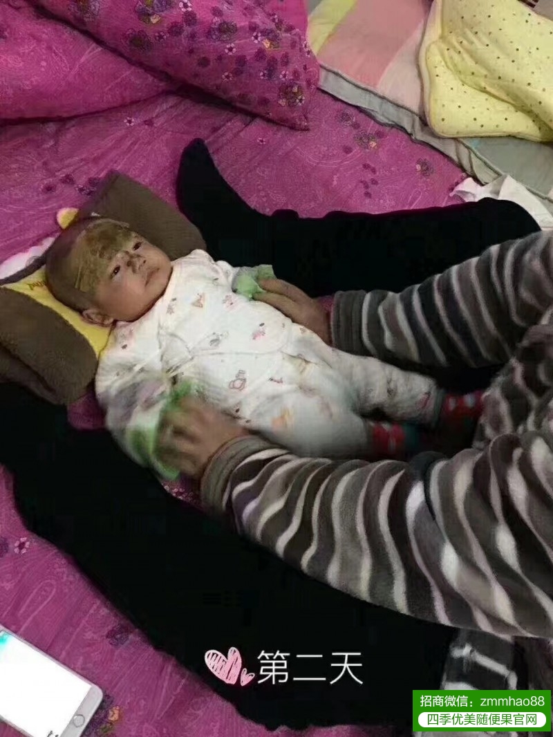 夏天湿热重，随便果水如何改善小孩湿疹？